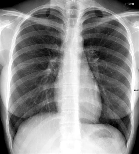 Normal Pa Radiograph Of The Chest Young Female Pa