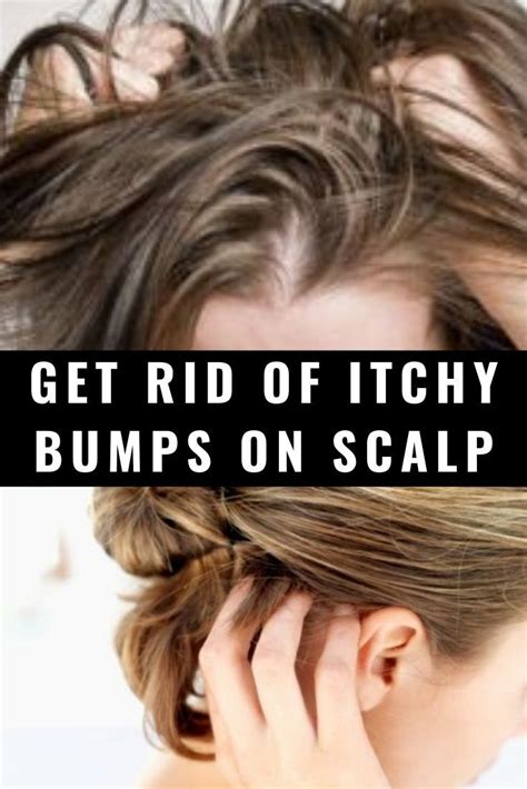 Get Rid Of Itchy Bumps On Scalp Itchy Bumps Scalps Itchy