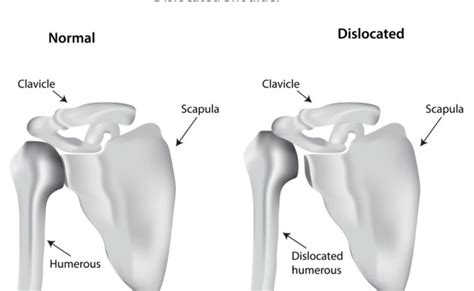 Shoulder Dislocation Causes Symptoms Treatment Braces Otosection