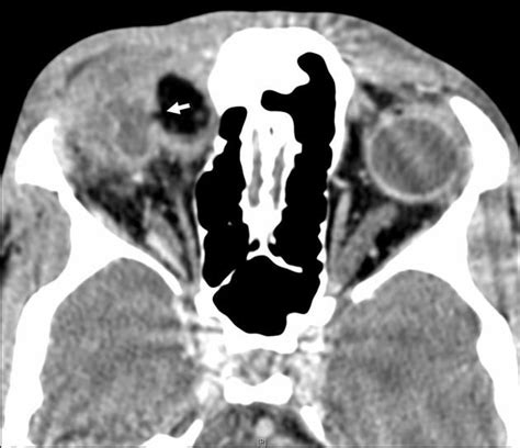 Ruptured Orbital Dermoid Cyst Dermoid Cyst Cysts Radiology