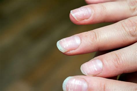 Iron Deficiency Anemia Nails