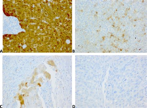 Representative Examples Of P16 Immunostaining On 1 Tumor P16 Positive