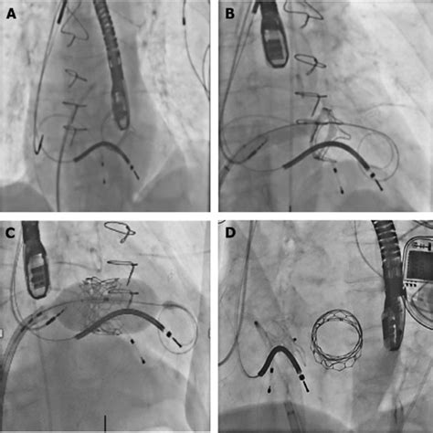 Inspiris Resilia Aortic Bioprosthetic Valve Edwards Lifesciences