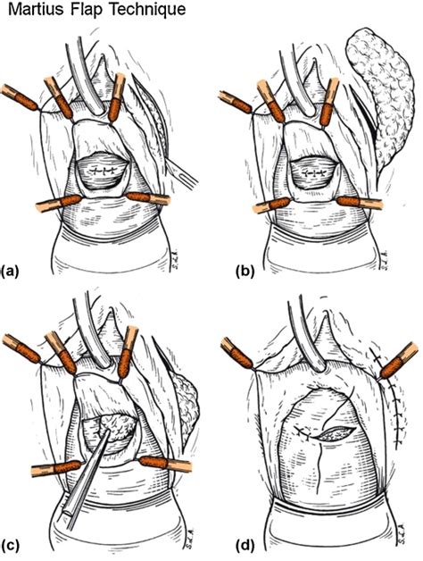 Surgical Repair Of Rectovaginal Fistulas In Patients With Crohn S