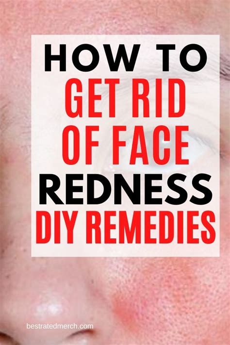 How To Get Rid Of Redness On The Face Home Remedies And Tips For Red