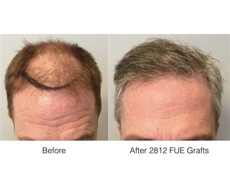 Fue Hair Transplant In Norwood Patient Marc Dauer Md Hair