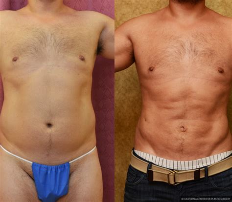 Patient Male Liposuction Abdomen Before And After Photos Beverly