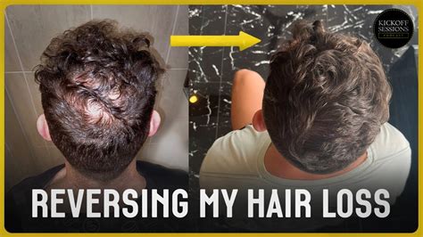 How I Reversed My Hair Loss Year Transformation No Hair