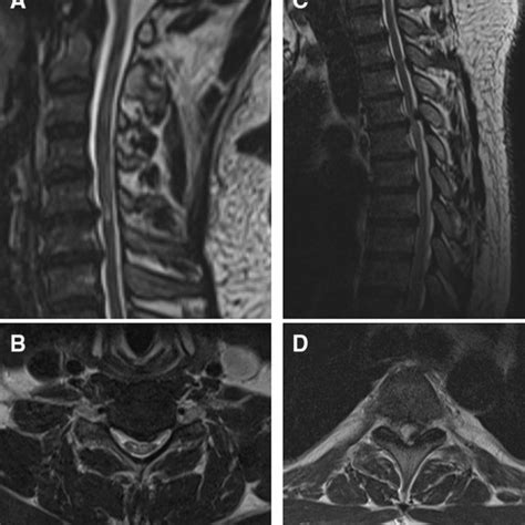 Imaging From Case 1 A Sagittal T2 Weighted Mri Of The Cervical Spine