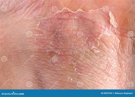 Eczema On Skin Stock Photo Image Of Sclerosis Closeup 8959704