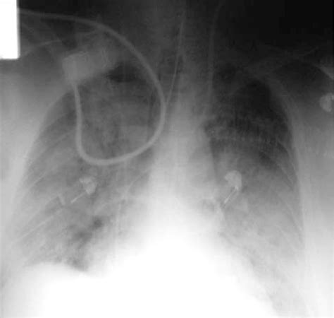 Chest X Ray On The 2nd Day Of Hospitalization Persisting Picture Of