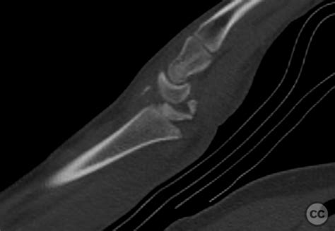 Malunion Salter Iii Distal Radius Fracture Dislocation