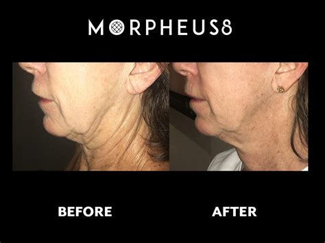 morpheus8 purelife medi spa wellness and skincare