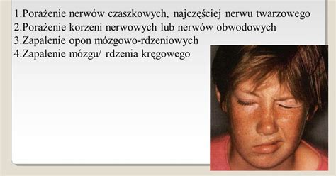 Borelioza Barbara Plucinska Choroba Z Lyme Zapalenie Opon M Zgowo