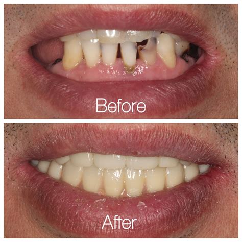 Before And After Successful Full Mouth Implantsrestoration Dental