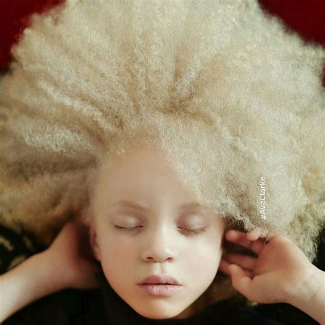 Keindahan Unik Orang Albino