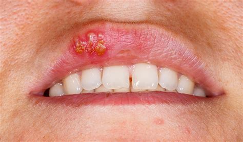 Stomatitis How Dental Professionals Treat And Manage These Conditions