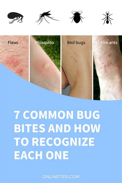 What Is Best For Itchy Bug Bites