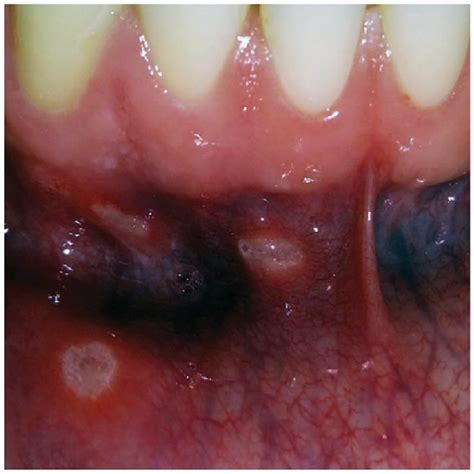 Small Ulcers Of Recurrent Aphthous Stomatitis Minor Type Mikulicz