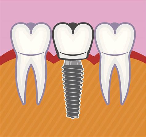 Dental Implant Clip Art Vector Images And Illustrations Istock
