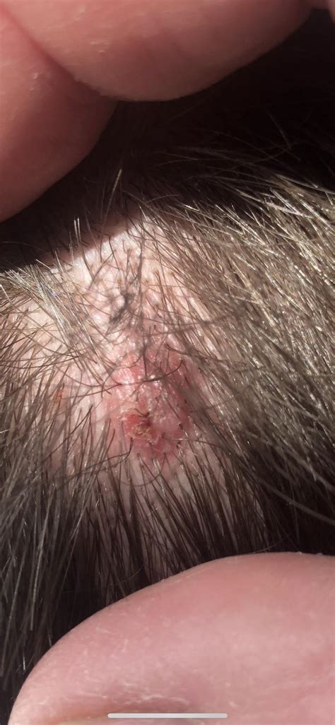 Skin Cancer In Hair