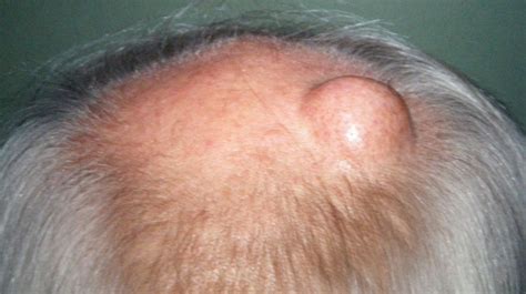 cherry angioma on scalp treatment hemangiomas skin conditions we treat medical dermatology
