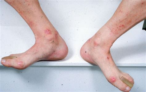 What Does Foot Eczema Look Like