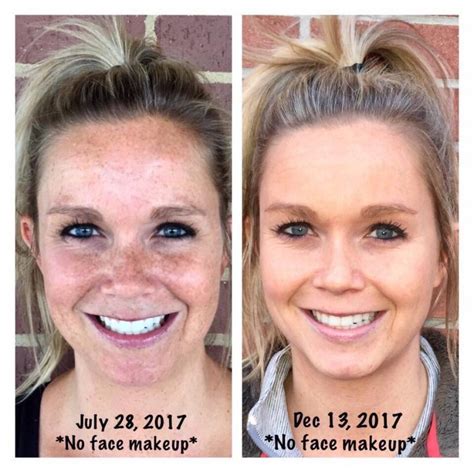 Before And After Using Rodan And Fields Reverse Brightening Rodan And