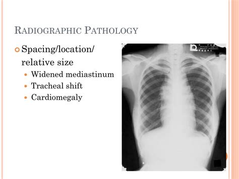 Ppt Cxr Review Powerpoint Presentation Free Download Id464249