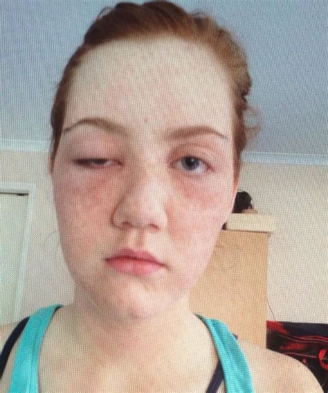 15 Year Old Teen Allergic Reaction Swollen Eyes And Face Rash A