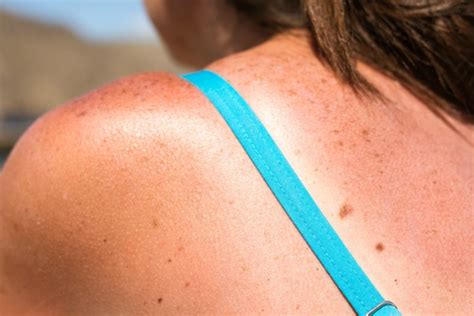 4 Ways To Prevent Sunburn This Summer Couponing 101
