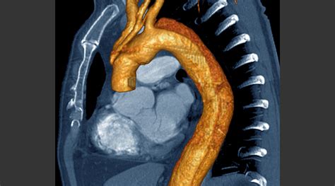 Outcomes Associated With Branched Endografts For Chronic Aortic Arch