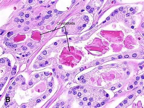 American Urological Association Prostatic Adenocarcinoma General