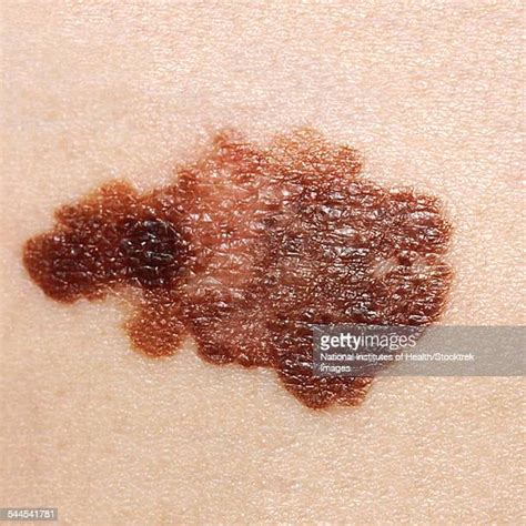 Melanoma Stock Photos And Pictures Getty Images