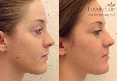 Mole Removal Before And After Core Plastic Surgery