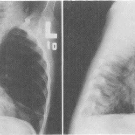 FIGURE Postero Anterior And Lateral Chest X Rays Showing Lobar