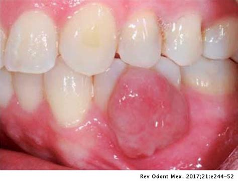 Oral Pyogenic Granuloma Diagnosis And Treatment A Series Of Cases