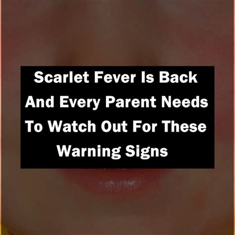 Scarlet Fever Is Back And Every Parent Needs To Watch Out For These