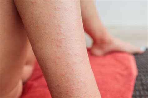 Gluten Rash Symptoms What Is It And How To Treat It Imaware™