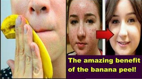 Banana Peel Home Remedies Youtube