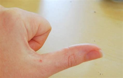 Seed Wart On Finger About Wart Removal And Treatment October 2010