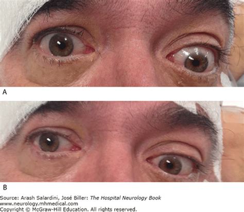 Approach To Acute Visual Changes Abnormal Eye Movements And Double