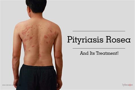 Pityriasis Rosea And Its Treatment By Dr Shaurya Rohatgi Lybrate