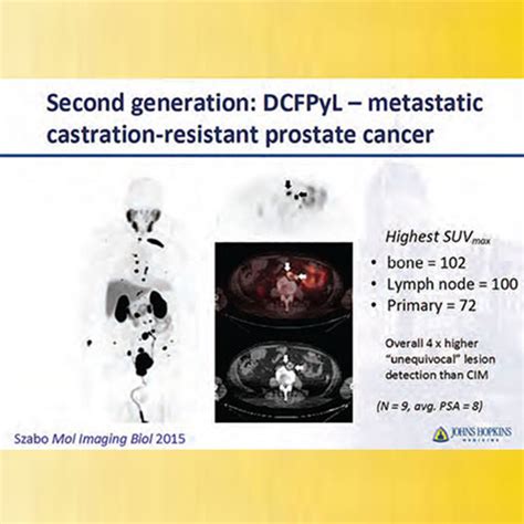 Breakthrough In Prostate Cancer Imaging Johns Hopkins Medicine