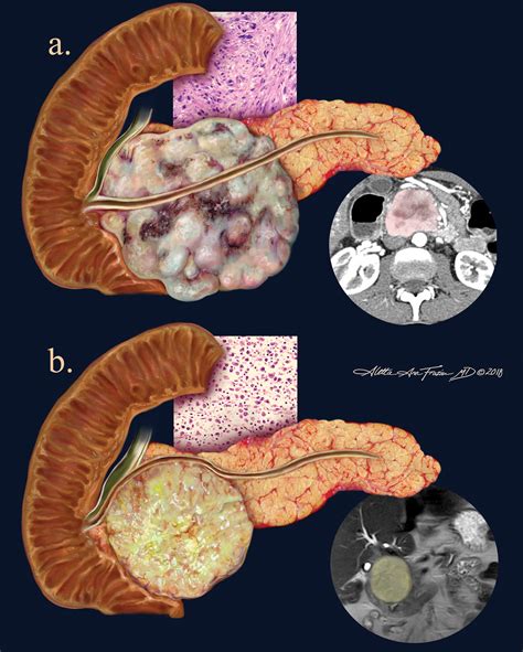 Nonepithelial Pancreatic Neoplasms Sarcoma Versus Lymphoma Radiographics