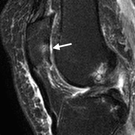 Articular Cartilage In The Knee Current Mr Imaging Techniques And