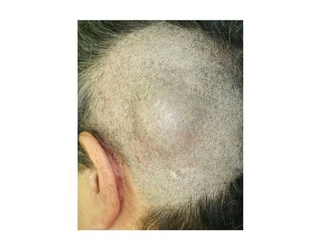 Two Cases Of Metastases To The Scalp Bone Mimicking Epidermoid Cyst