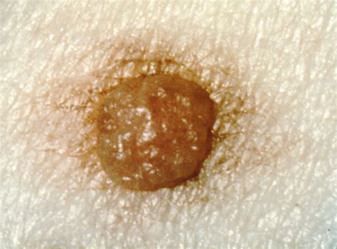 Moles Types Causes Treatment And Diagnosis