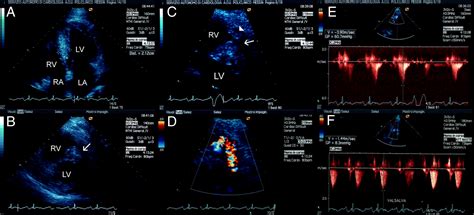 Right Ventricular Outflow Tract Obstruction In Hypertrophic