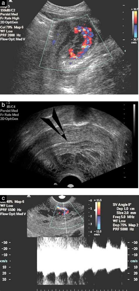 Organized Hematoma Ultrasound